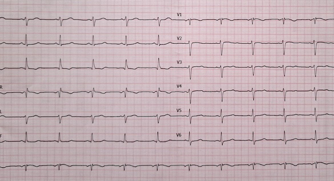 Pomiar ekg na kartce